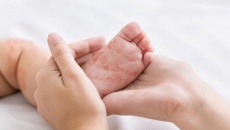 Bất dung nạp lactose hoàn toàn khác dị ứng đạm sữa bò  