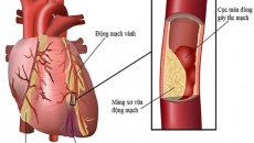 Xơ vữa động mạch vành: Biến chứng và cách phòng ngừa từ thảo dược 