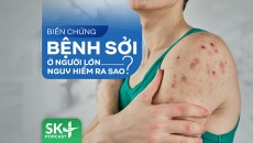 Podcast: Biến chứng bệnh sởi ở người lớn nguy hiểm ra sao?