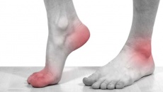 Nhận biết triệu chứng gout cấp tính để điều trị từ sớm