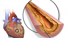 Biến chứng nguy hiểm của xơ vữa động mạch vành và cách phòng ngừa từ thảo dược 