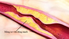 Xơ vữa động mạch gây ra biến chứng gì?
