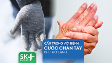 Podcast: Cẩn trọng với bệnh cước chân tay khi trời lạnh