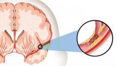Nhận biết sớm dấu hiệu nhồi máu não