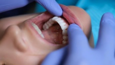 Bệnh nướu răng và não bộ: Mối liên hệ là gì?