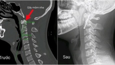 Hy vọng mới cho những người trẻ gặp chấn thương cột sống nghiêm trọng