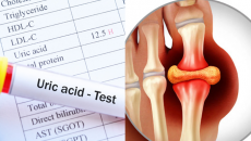 Dấu hiệu acid uric tăng cao và biện pháp kiểm soát