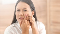 Bí quyết “đánh bay” mụn trứng cá hiệu quả nhanh