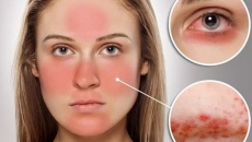 Bệnh lupus ban đỏ có chữa khỏi được không?