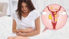 Những lầm tưởng thường gặp về nhân xơ tử cung