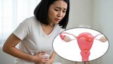 Chị em có đặc điểm nào dễ mắc lạc nội mạc tử cung?