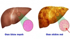 Gan nhiễm mỡ có mấy cấp độ, cấp độ nào nguy hiểm nhất?
