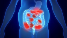 3 dấu hiệu cảnh báo sớm bệnh crohn 