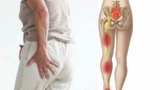 Cách phòng ngừa bệnh đau thần kinh tọa