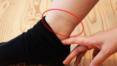 Vết tất hằn trên chân cảnh báo nhiều vấn đề sức khỏe