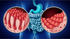 4 quan niệm sai lầm phổ biến về bệnh Celiac 
