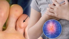 3 dấu hiệu ở bàn chân cảnh báo bệnh tim 