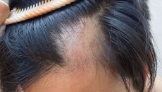 Mẹo làm đẹp giúp người bị rụng tóc từng mảng lấy lại tự tin