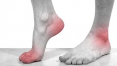 Triệu chứng cảnh báo bệnh gout và giải pháp cải thiện hiệu quả