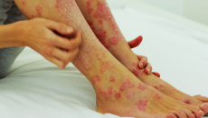 Phiền toái do bệnh vảy nến và giải pháp kiểm soát hiệu quả từ thảo dược