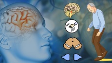 7 tác nhân làm tăng nguy cơ mắc bệnh Parkinson