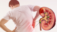 Nồng độ testosterone thấp làm tăng nguy cơ sỏi thận ở nam giới 