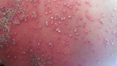 Mối lo ngại về bệnh vảy nến thể mủ