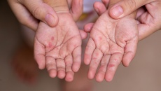 Cách phòng bệnh tay chân miệng mùa Hè