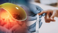 Sỏi bùn túi mật kèm đái tháo đường dùng TPBVSK Kim Đởm Khang được không?