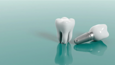 Khi nào nên thực hiện cấy ghép Implant cho răng?