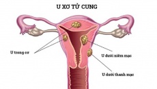 U xơ tử cung dưới niêm mạc có nguy hiểm không?