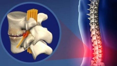 Hiểu về các giai đoạn thoái hóa cột sống