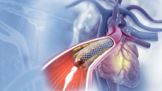 Đặt stent rồi có tránh được nhồi máu cơ tim không?