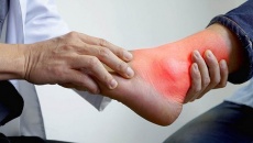 Chế độ ăn cho người bị đau gout cấp: Nên ăn và kiêng gì?