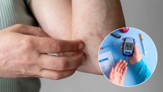 Người bệnh đái tháo đường bị ngứa da, càng gãi càng ngứa có nguy hiểm không?