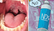 Cảnh báo nguy cơ bỏng lạnh khi lạm dụng khí N2O