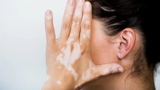 Những điều cần biết về bệnh bạch biến