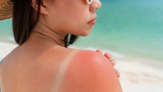 Mách bạn cách cải thiện cháy nắng hiệu quả
