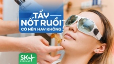 Podcast: Tẩy nốt ruồi có nên hay không?