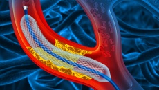 Đặt stent 2 tháng vẫn nhói ngực và mệt phải làm sao?