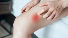 5 cách để giảm ma sát và bảo vệ da khi chơi thể thao