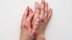 Vảy nến và nguy cơ viêm khớp: Những thông tin bạn cần biết