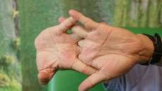 Thói quen bẻ khớp ngón tay có gây ra tình trạng viêm khớp?