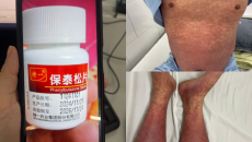 Người bệnh xương khớp cần cảnh giác với thuốc chống viêm Phenylbutazone