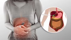 Đau quặn hạ sườn phải, thường xuyên khó tiêu có phải do sỏi mật?
