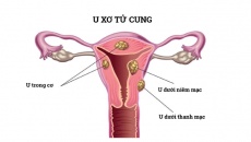 U xơ tử cung dưới thanh mạc là gì?