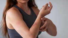 Mẹo xử lý phát ban da do quần áo ẩm ướt