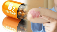 Lợi ích của vitamin B2 với người bệnh vảy nến
