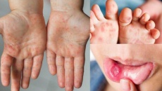 Biến chứng thường gặp của bệnh tay chân miệng