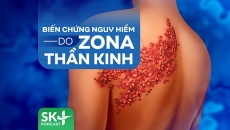 Podcast: Biến chứng nguy hiểm do Zona thần kinh